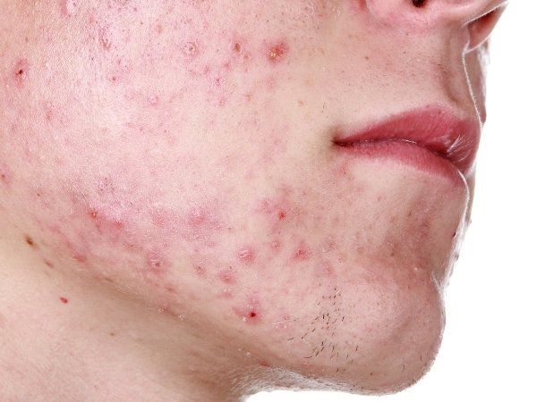 acne