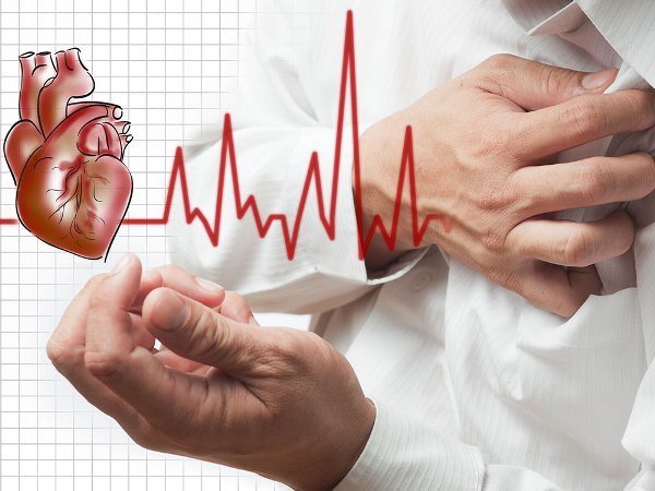 myocardial-infarction