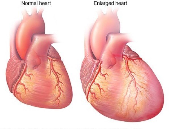 enlarged-heart-2